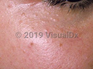 Clinical image of Syringoma - imageId=160788. Click to open in gallery.  caption: 'Many translucent and light brown papules on the cheek and inferior eyelid.'