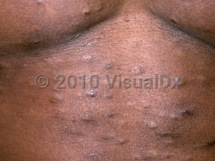 Clinical image of Steatocystoma multiplex - imageId=160832. Click to open in gallery.  caption: 'Many whitish-yellow and brown, smooth papules on the lower chest and abdomen.'