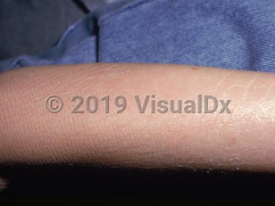 Clinical image of Sjögren-Larsson syndrome - imageId=1611776. Click to open in gallery.  caption: 'Xerotic, linear, and ichthyotic plaques on the arm.'