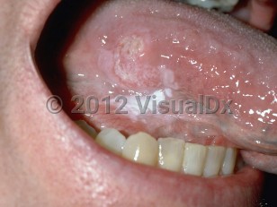 Clinical image of Oral squamous cell carcinoma - imageId=161727. Click to open in gallery.  caption: 'An ulcerated pink and white plaque on the lateral tongue.'