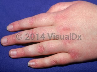 Clinical image of Juvenile dermatomyositis - imageId=1636572. Click to open in gallery.  caption: 'Faintly violaceous and erythematous papules and patches over the knuckles (atrophic dermal papules).'