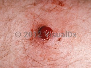 Clinical image of Lobular capillary hemangioma - imageId=163970. Click to open in gallery.  caption: 'A close-up of a well-demarcated bleeding papule.'