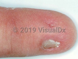 Clinical image of Congenital onychodysplasia - imageId=1646179. Click to open in gallery.  caption: 'Micronychia in congenital onychodystrophy of the index finger (COIF) syndrome.'