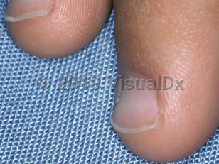 Clinical image of Iron deficiency anemia - imageId=1651599. Click to open in gallery.  caption: 'Spoon-shaped fingernails in a child.'