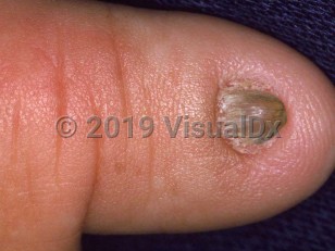 Clinical image of Congenital micronychia - imageId=1654133. Click to open in gallery.  caption: 'Isolated micronychia and dystrophy of a toenail.'