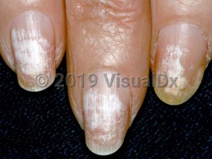 Clinical image of Nail polish damage - imageId=1654463. Click to open in gallery.  caption: 'Keratin granulation leading to leukonychia.'