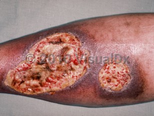 Clinical image of Antiphospholipid antibody syndrome - imageId=166082. Click to open in gallery.  caption: 'Large, deep, granulating, slough-covered ulcers with surrounding hyperpigmentation and erythema on the leg.'