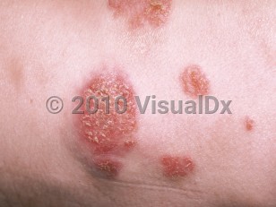 Clinical image of Cryptococcosis - imageId=166184. Click to open in gallery.  caption: 'A close-up of scaly and crusted papules and plaques some with a vegetating topography.'