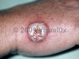 Clinical image of Bromoderma - imageId=166924. Click to open in gallery.  caption: 'A large purulent bulla with a central superficial ulcer and a rim of erythema on the dorsal hand.'
