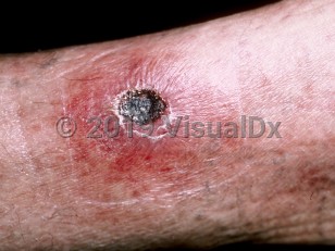 Clinical image of Rickettsialpox - imageId=167281. Click to open in gallery.  caption: 'An eschar with a surrounding erythematous plaque on the leg.'
