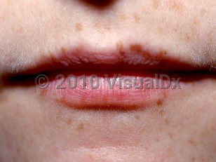 Clinical image of Carney complex - imageId=1690571. Click to open in gallery.  caption: 'Numerous perioral tan macules.'