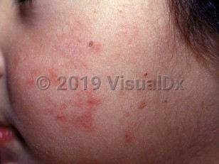 Clinical image of Congenital erythropoietic porphyria - imageId=1691868. Click to open in gallery.  caption: 'Tiny round crusts and erythematous macules and patches on the cheek.'
