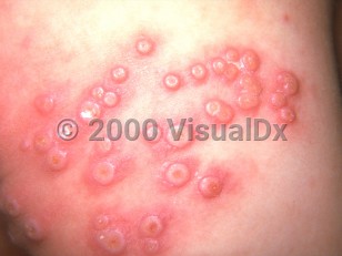 Clinical image of Eczema vaccinatum vaccinia - imageId=169206. Click to open in gallery.  caption: 'A close-up of a cluster of umbilicated and crusted pustules, each with an erythematous halo.'