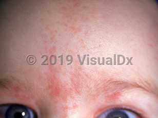 Clinical image of Salmon patch - imageId=1705028. Click to open in gallery.  caption: 'Reddish macules and patches on the central forehead and upper eyelids.'