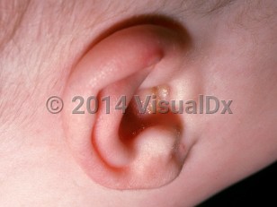 Clinical image of Subepidermal calcified nodule - imageId=1730361. Click to open in gallery.  caption: 'A white papule at the upper helix.'