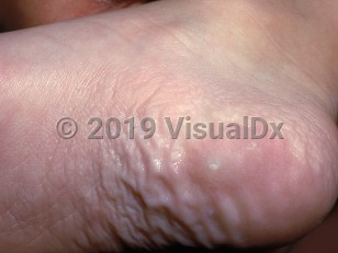 Clinical image of Calcified nodules of the heels - imageId=1730421. Click to open in gallery.  caption: 'A shiny papule on the heel.'