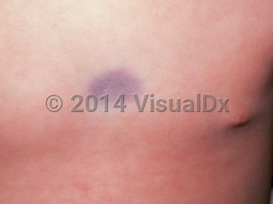 Clinical image of Arteriovenous malformations - imageId=1735267. Click to open in gallery.  caption: 'A close-up of a violaceous plaque on the chest.'