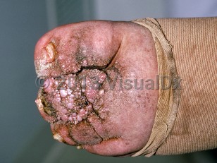 Clinical image of Elephantiasis nostras verrucosa - imageId=175539. Click to open in gallery.  caption: 'Marked lymphedema of the foot with multiple shiny pink papules and brown spicules over the toes.'