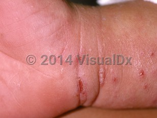 Clinical image of Scabies - imageId=177763. Click to open in gallery.  caption: 'Excoriations and a burrow at the wrist.'