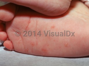 Clinical image of Scabies (pediatric) - imageId=1777728. Click to open in gallery.  caption: 'Burrows and pink, scaly papules on the sole.'