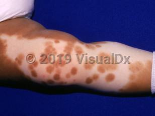 Clinical image of Piebaldism - imageId=1780154. Click to open in gallery.  caption: 'A large depigmented patch with blotches of preserved pigment, on the leg.'