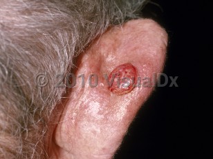 Clinical image of Cutaneous squamous cell carcinoma - imageId=178723. Click to open in gallery.  caption: 'An eroded nodule on the posterior pinna.'