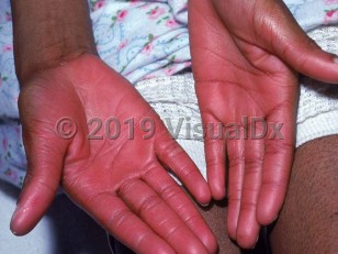 Clinical image of Malabsorption syndrome - imageId=1814371. Click to open in gallery.  caption: 'Diffuse bright pink erythema of the palms and fingers.'