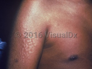 Clinical image of Hunter syndrome - imageId=1816319. Click to open in gallery.  caption: 'Smooth, slightly hypopigmented papules and small plaques on the arm.'