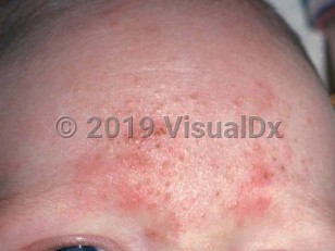 Clinical image of Eosinophilic pustular folliculitis in infancy - imageId=1836643. Click to open in gallery.  caption: 'Numerous tiny papules and crusts on the forehead.'