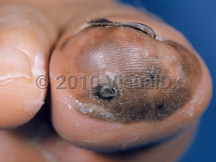 Clinical image of Acral lentiginous melanoma - imageId=1847552. Click to open in gallery.  caption: 'A variegated brown and black, asymmetric plaque on the distal toe with pigment in the toenail.'