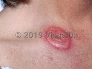 Clinical image of Acute febrile neutrophilic dermatosis - imageId=1858339. Click to open in gallery.  caption: 'A well-demarcated, deep pink, pseudovesicular plaque over the medial clavicle.'