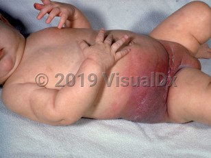Clinical image of Kasabach-Merritt syndrome - imageId=1859794. Click to open in gallery. 