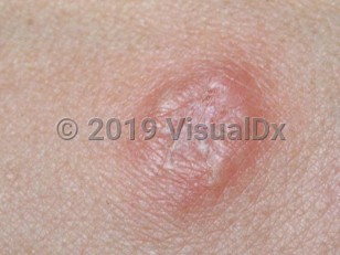 Clinical image of Brucellosis - imageId=1874956. Click to open in gallery. 