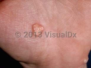 Clinical image of Calcinosis cutis - imageId=187712. Click to open in gallery.  caption: 'Yellow and white small plaques with irregular surfaces on the palm.'