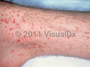 Clinical image of Atypical measles - imageId=1897265. Click to open in gallery.  caption: 'Numerous purpuric macules and papules on the leg.'