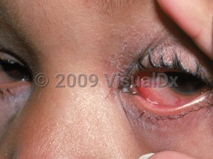 Clinical image of Viral conjunctivitis - imageId=1917410. Click to open in gallery.  caption: 'Marked conjunctival injection, purulence at the caruncle, and crusting along the eyelid margins.'