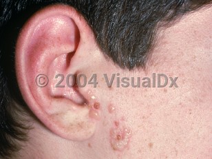 Clinical image of Gladiatorum herpes simplex virus - imageId=1919336. Click to open in gallery.  caption: 'A cluster of vesicles on the lateral cheek.'