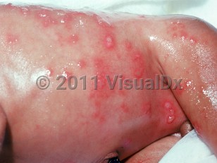 Clinical image of Neonatal herpes simplex virus - imageId=1919626. Click to open in gallery.  caption: 'Multiple clustered and single vesicles of differing sizes, with background erythema, on the flank, abdomen, and thigh.'