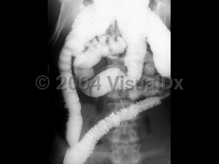 Imaging Studies image of Amebic colitis - imageId=1926452. Click to open in gallery. 