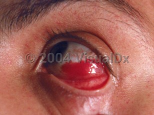 Clinical image of Subconjunctival hemorrhage - imageId=1932109. Click to open in gallery.  caption: 'A sizeable conjunctival hemorrhage secondary to coughing spells.'