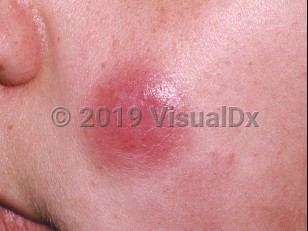 Clinical image of Adult T-cell leukemia/lymphoma - imageId=193856. Click to open in gallery.  caption: 'A pink nodule on the cheek.'