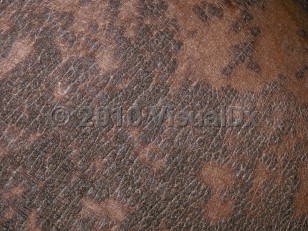 Clinical image of Confluent and reticulated papillomatosis - imageId=194083. Click to open in gallery.  caption: 'A close-up of confluent scaly, hyperpigmented, ridged papules.'
