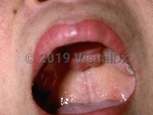 Clinical image of Torus palatinus - imageId=195584. Click to open in gallery.  caption: 'A large bosselated nodule arising from the hard palate.'