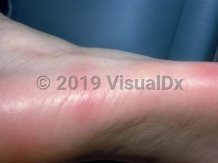 Clinical image of Palmar-plantar eccrine hidradenitis - imageId=2036064. Click to open in gallery.  caption: 'Erythematous plaques on the sole.'