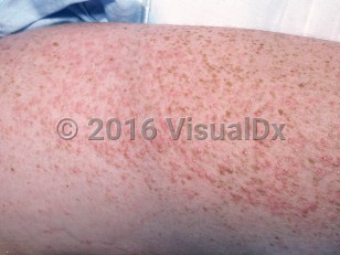 Clinical image of Miliaria rubra - imageId=2037503. Click to open in gallery. 