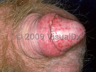 Clinical image of Balanoposthitis - imageId=2045951. Click to open in gallery.  caption: 'Numerous small round erosions on the foreskin and glans.'
