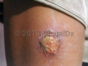 Clinical image of Yaws - imageId=2051484. Click to open in gallery.  caption: 'A purulent ulcer on an extremity.'