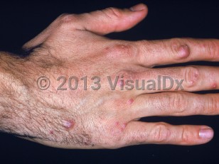 Clinical image of Sea urchin sting - imageId=2054859. Click to open in gallery. 