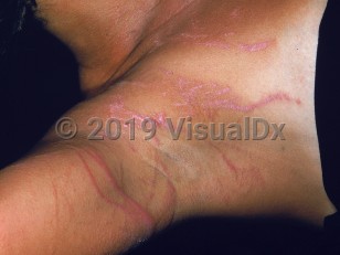 Clinical image of Portuguese man-of-war sting - imageId=2061396. Click to open in gallery.  caption: 'Pink, edematous and scaly papules and linear plaques on the chest, neck, and arm after jellyfish sting while swimming in the Bahamas.'