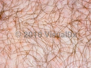 Clinical image of Pediculosis pubis - imageId=2074754. Click to open in gallery.  caption: 'Pubic lice and nits attached to pubic hair shafts.'